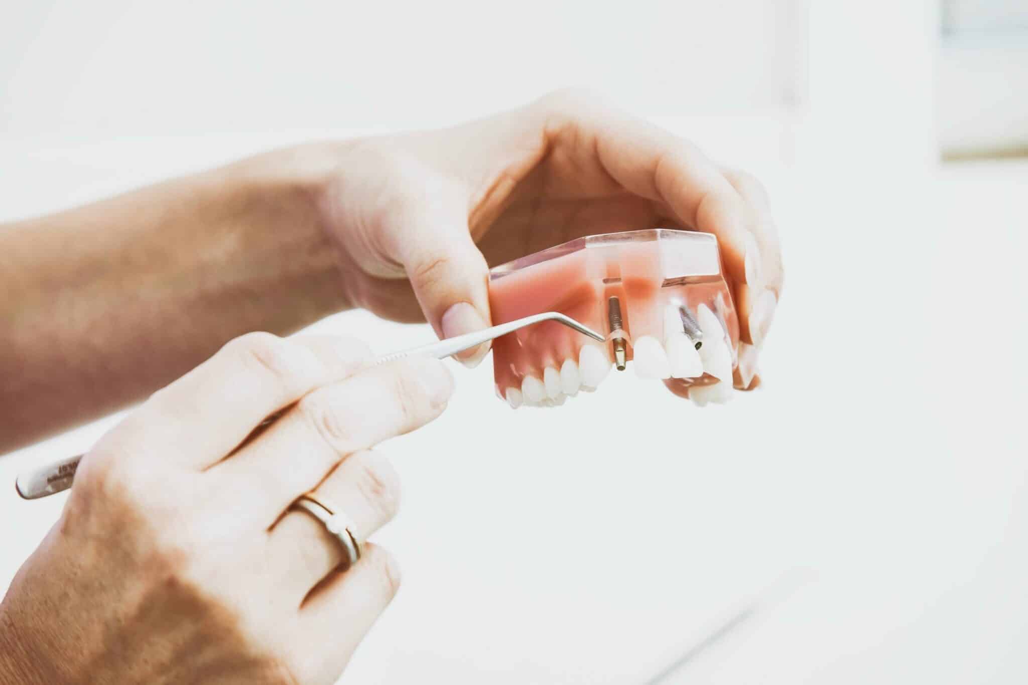 Dental Implants San Jose