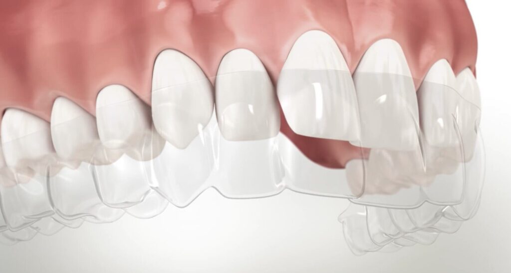 Orthodontics San Jose Experience the Difference Butterfly Dental Care