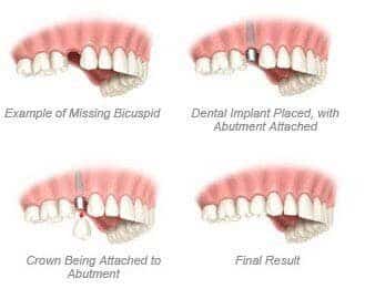 single-tooth-implant-midtown-nyc (1)