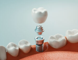 Dental Implants vs. Dentures: Which Is Right for You?