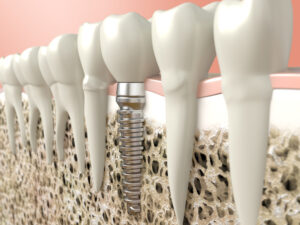 Rediscover the Joy of Eating with Dental Implants