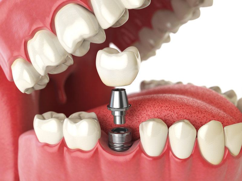 Dental Implant Options: Finding Your Perfect Smile