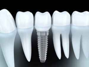 Dental Implants: Cavity-Free Teeth Replacement Option