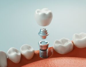 Your Dental Implant Journey: What to Expect at Butterfly