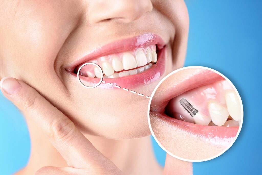 Implant-Supported Restorations: Your Guide