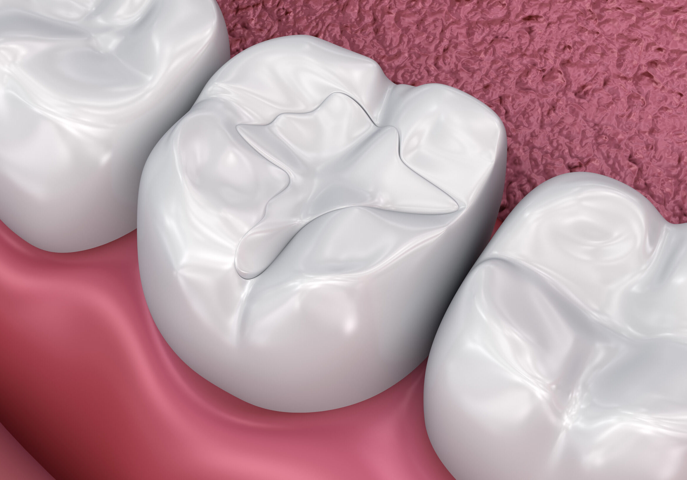 Dental fissure fillings, Medically accurate 3D illustration Dental fissure fillings, Medically accurate 3D illustration