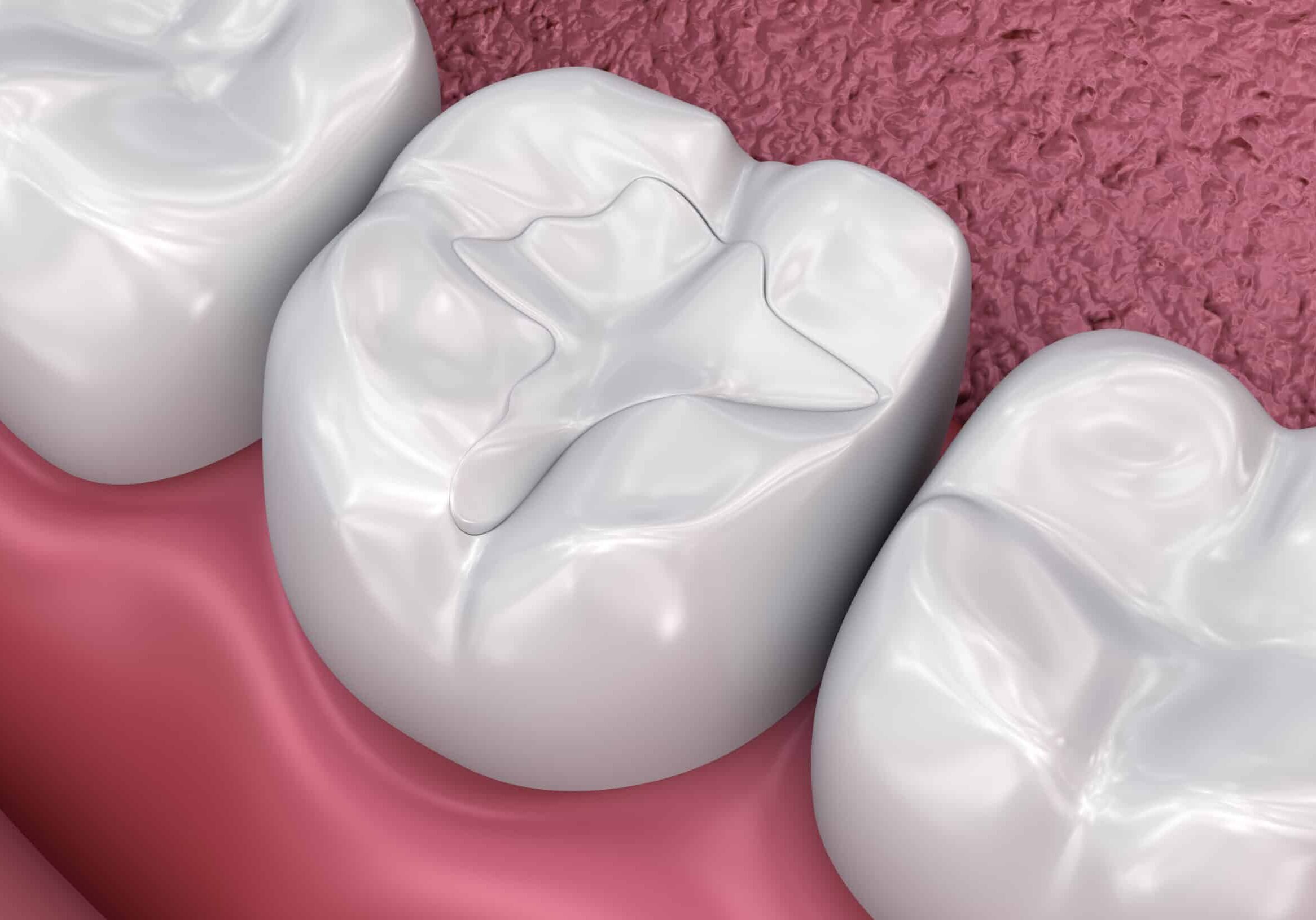 Dental fissure fillings, Medically accurate 3D illustration Dental fissure fillings, Medically accurate 3D illustration