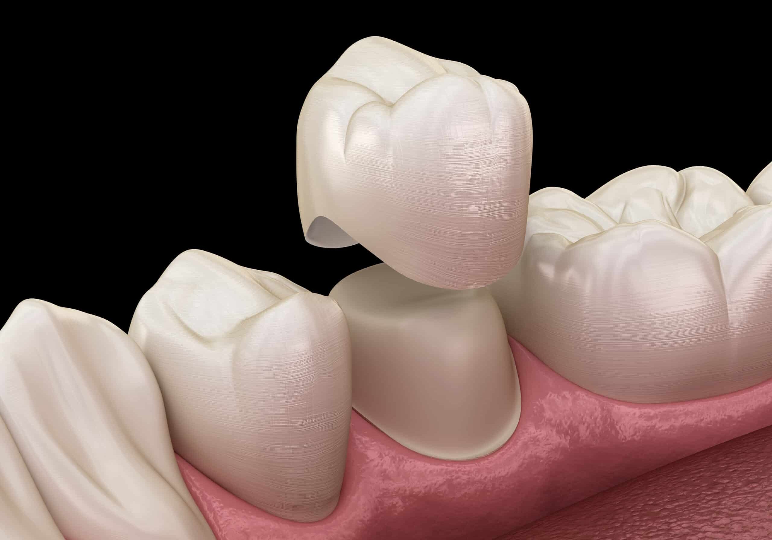 Dental crown premolar tooth assembly process. Medically accurate Dental crown premolar tooth assembly process. Medically accurate 3D illustration of human teeth treatment