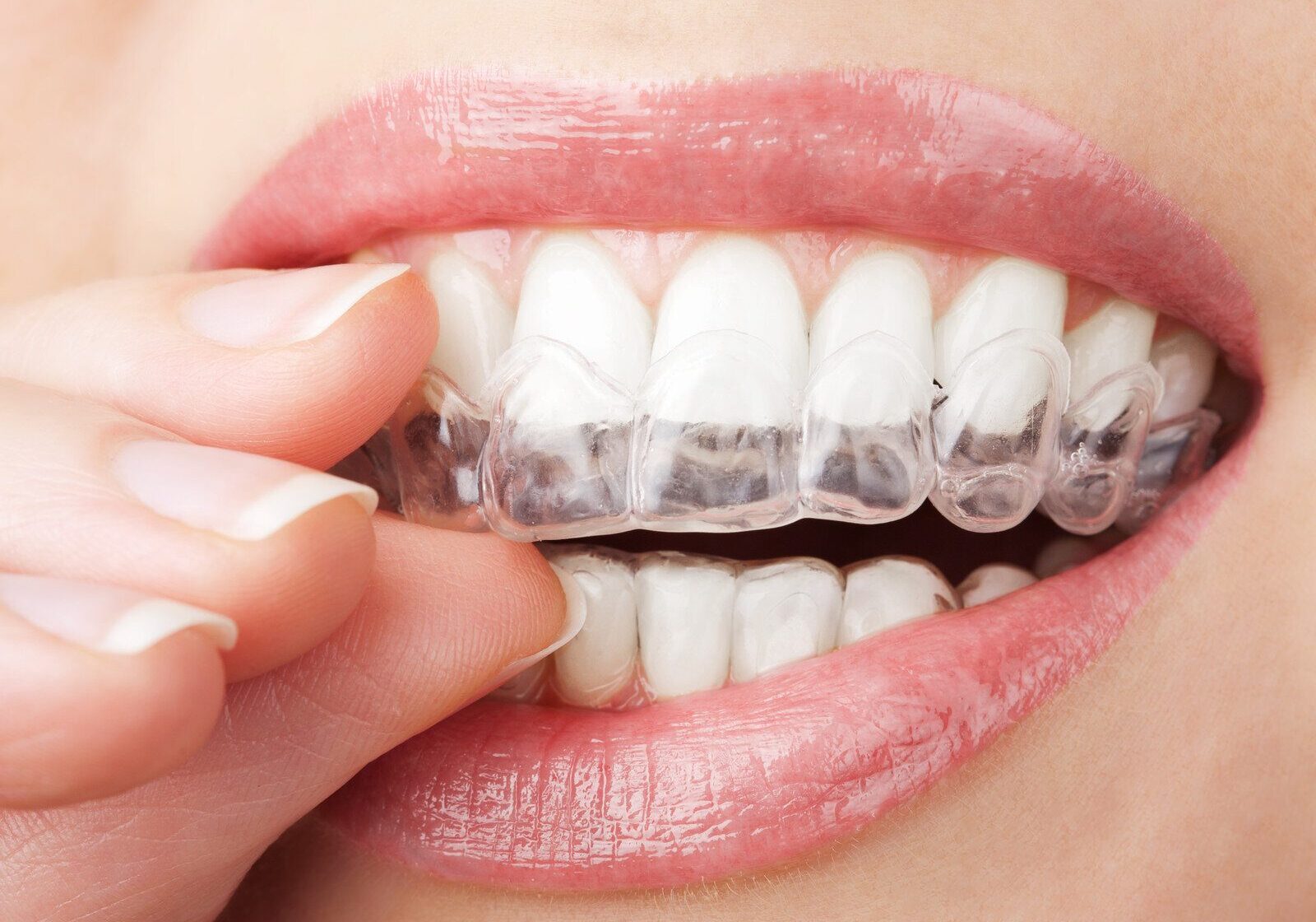 Clear+Aligners