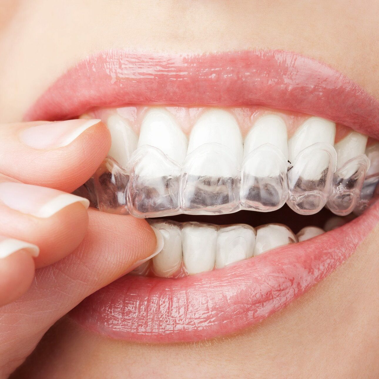 Clear+Aligners