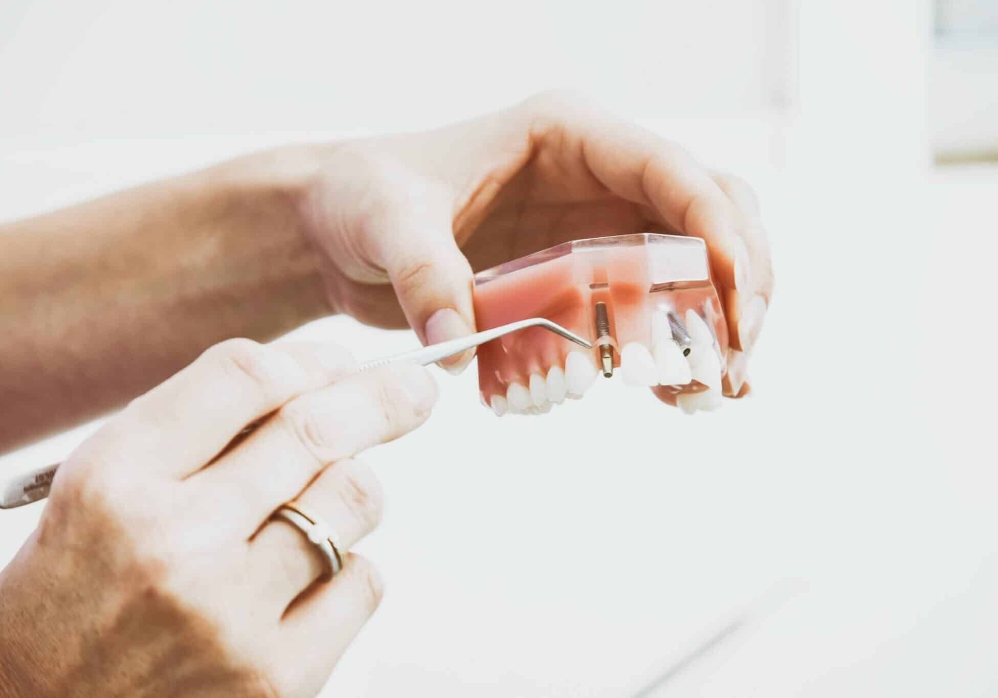 Dental Implants San Jose