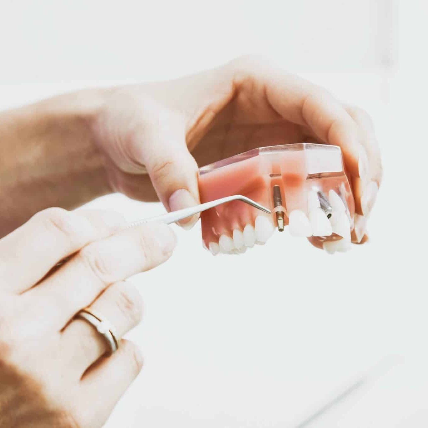 Dental Implants San Jose