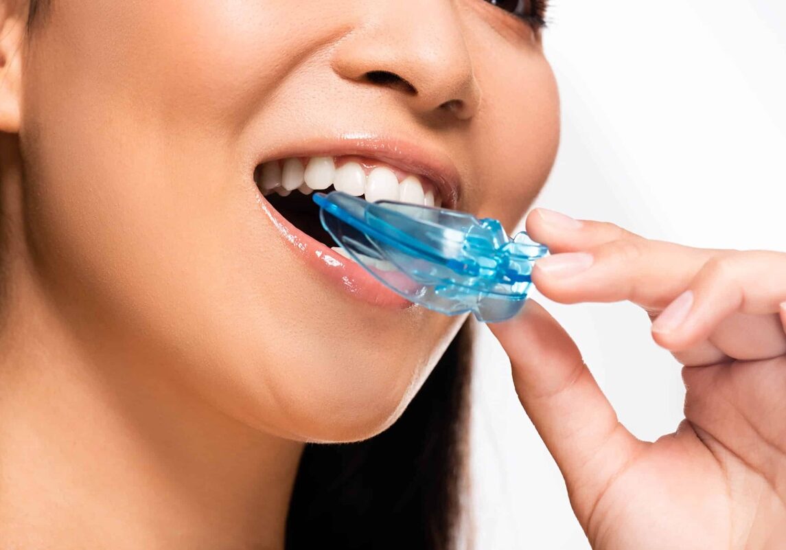 Mouth Guard Butterfly Dental Care San Jose CA
